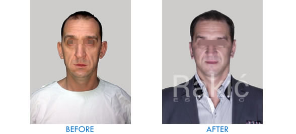 Face lift surgery